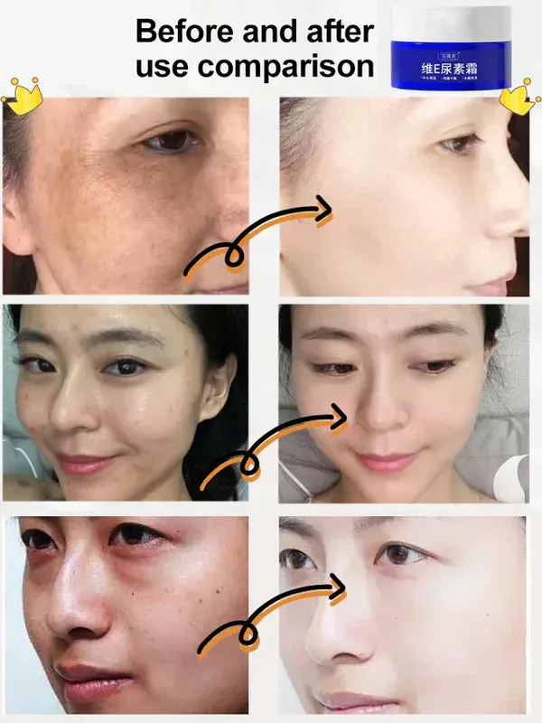 Korean Vitamin E Urea Cream 100g (BUY 1 GET 1 FREE)